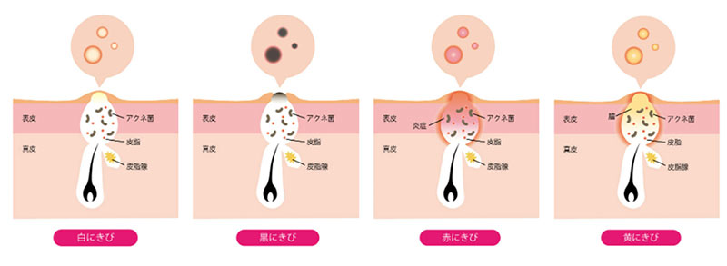 ぜニキビは繰り返すのか？そのメカニズム
