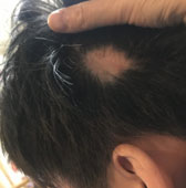 円形脱毛症でこんなお悩みありませんか？