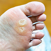 たこ・魚の目（鶏眼）でこんなお悩みありませんか？