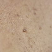 ウイルス性イボ（尋常性疣贅）でこんなお悩みありませんか？